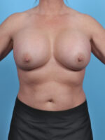 Breast Augmentation - Case 4866 - After