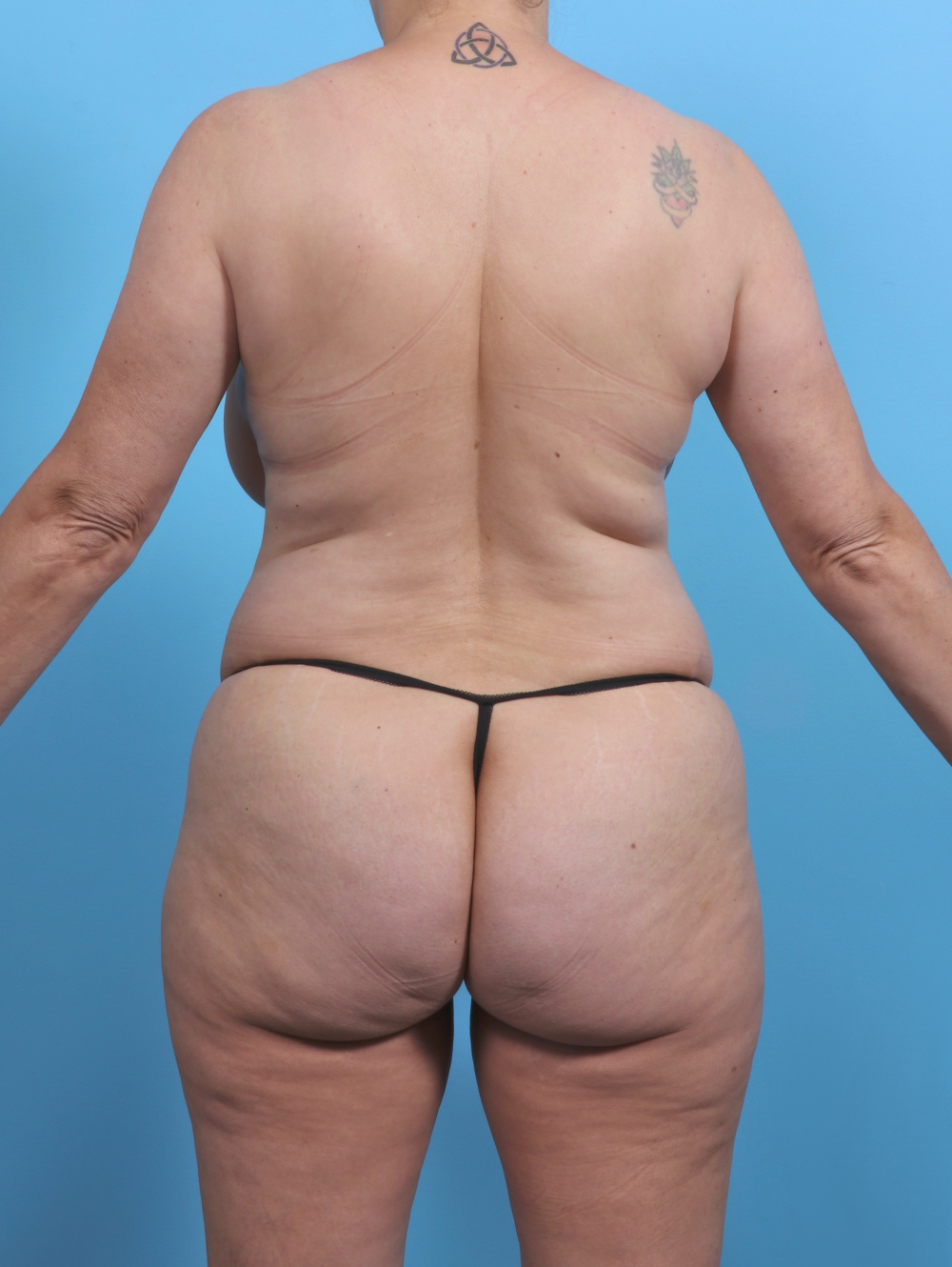 Liposuction Patient Photo - Case 4874 - before view-3