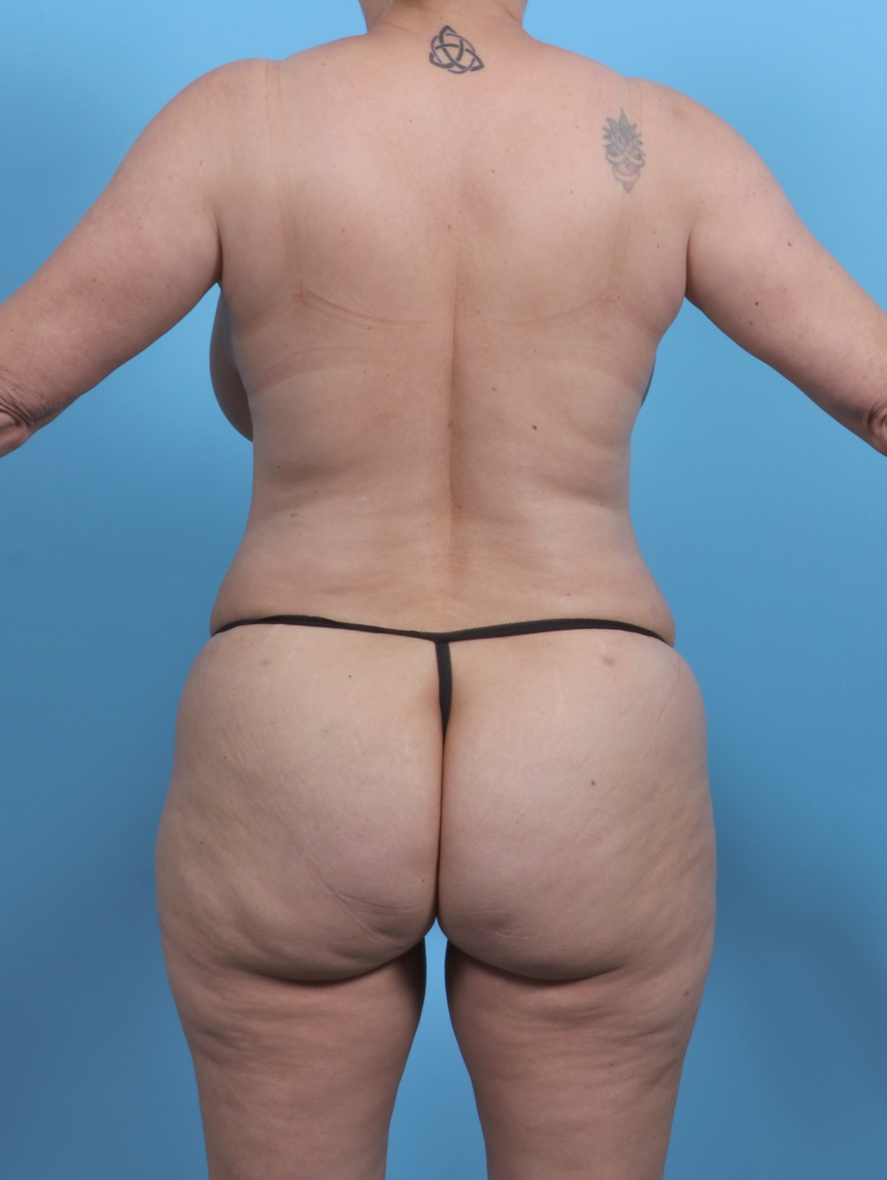 Liposuction Patient Photo - Case 4874 - after view-3