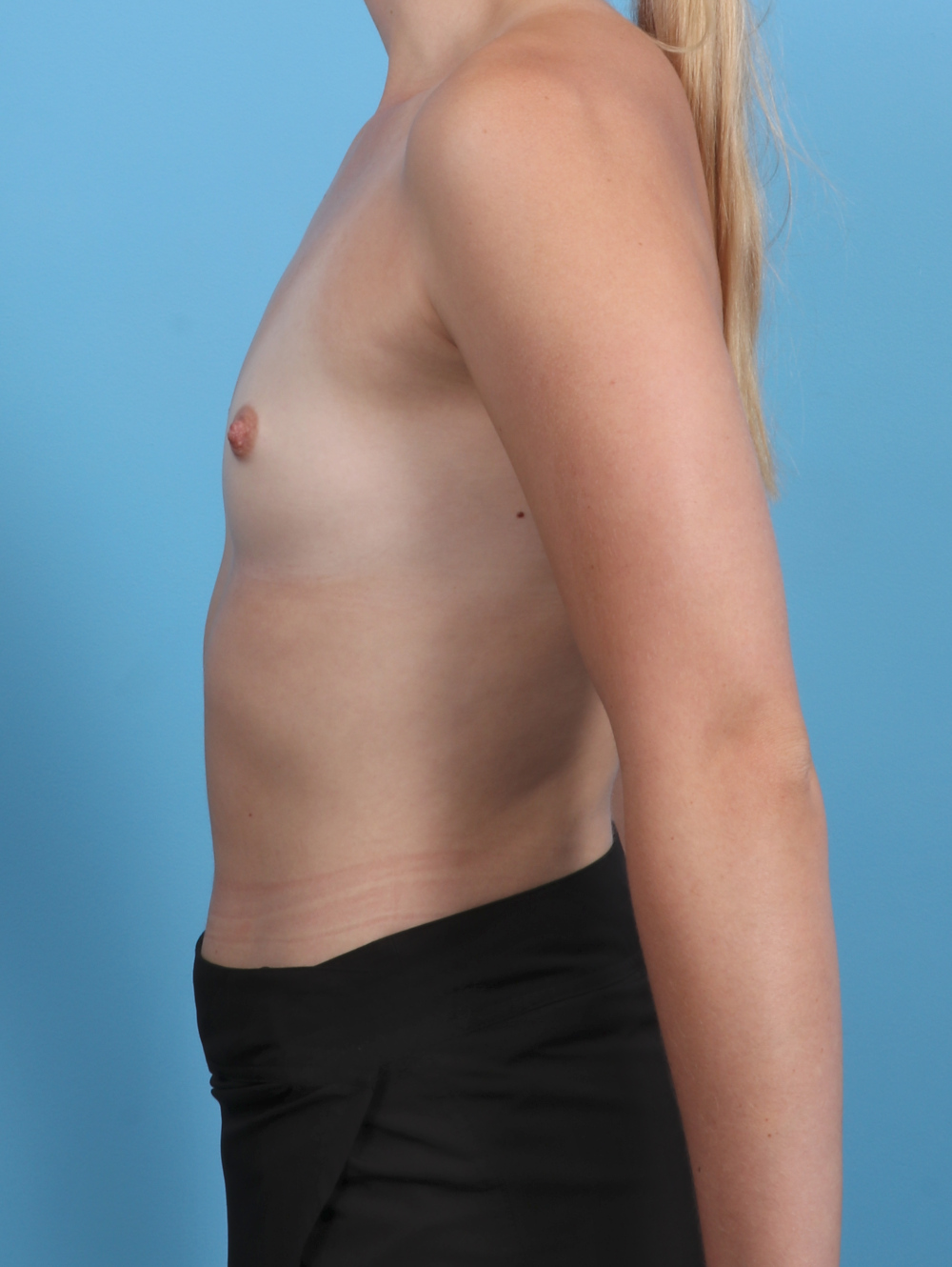 Breast Augmentation Patient Photo - Case 4902 - before view-2