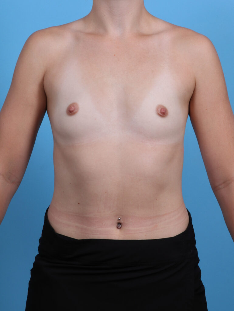 Breast Augmentation - Case 4902 - Before