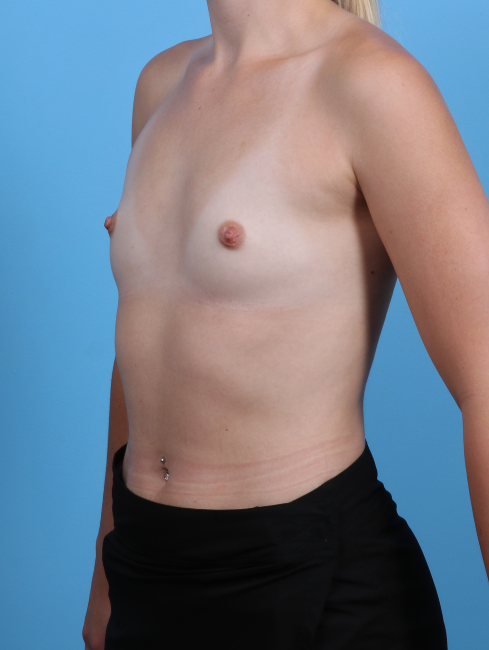 Breast Augmentation Patient Photo - Case 4902 - before view-1