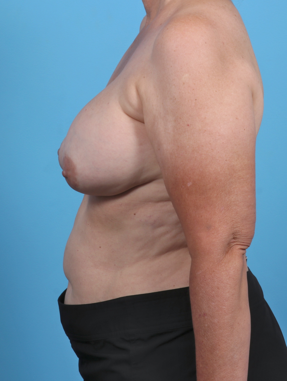 Breast Implant Revision Patient Photo - Case 4918 - before view-2