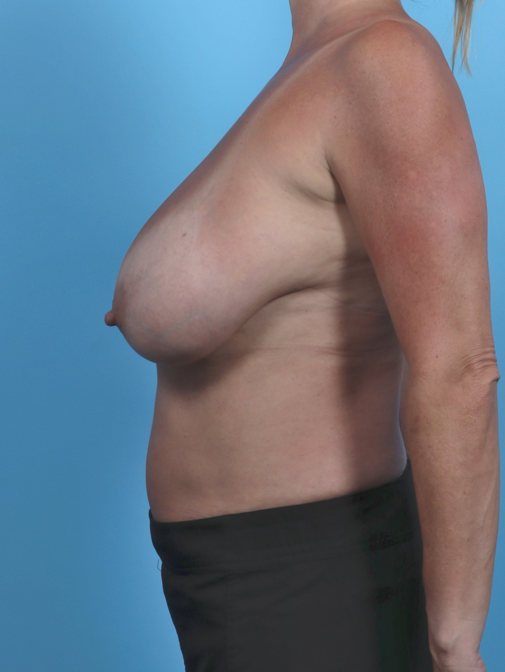 Breast Lift/Reduction Patient Photo - Case 4926 - before view-2