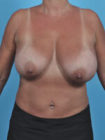 Breast Lift/Reduction - Case 4926 - Before