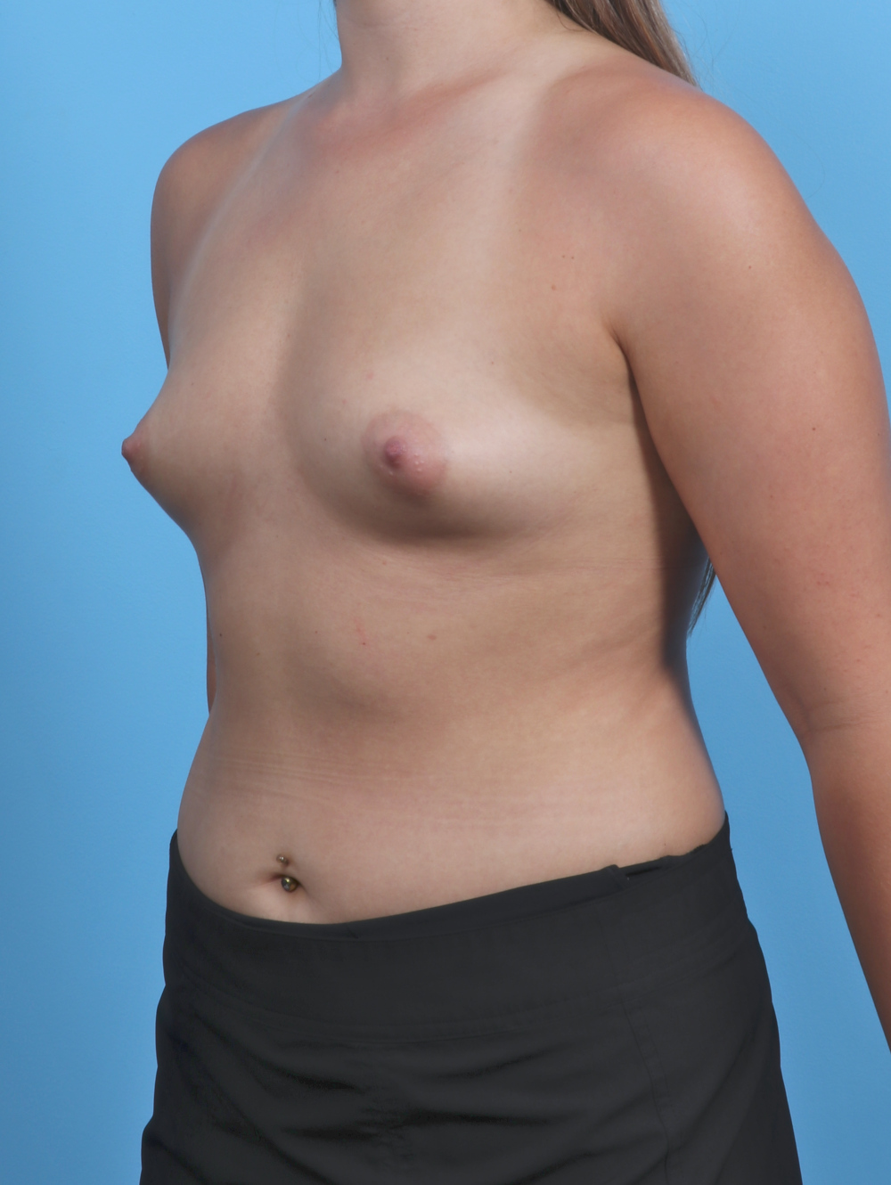 Breast Augmentation Patient Photo - Case 4934 - before view-1