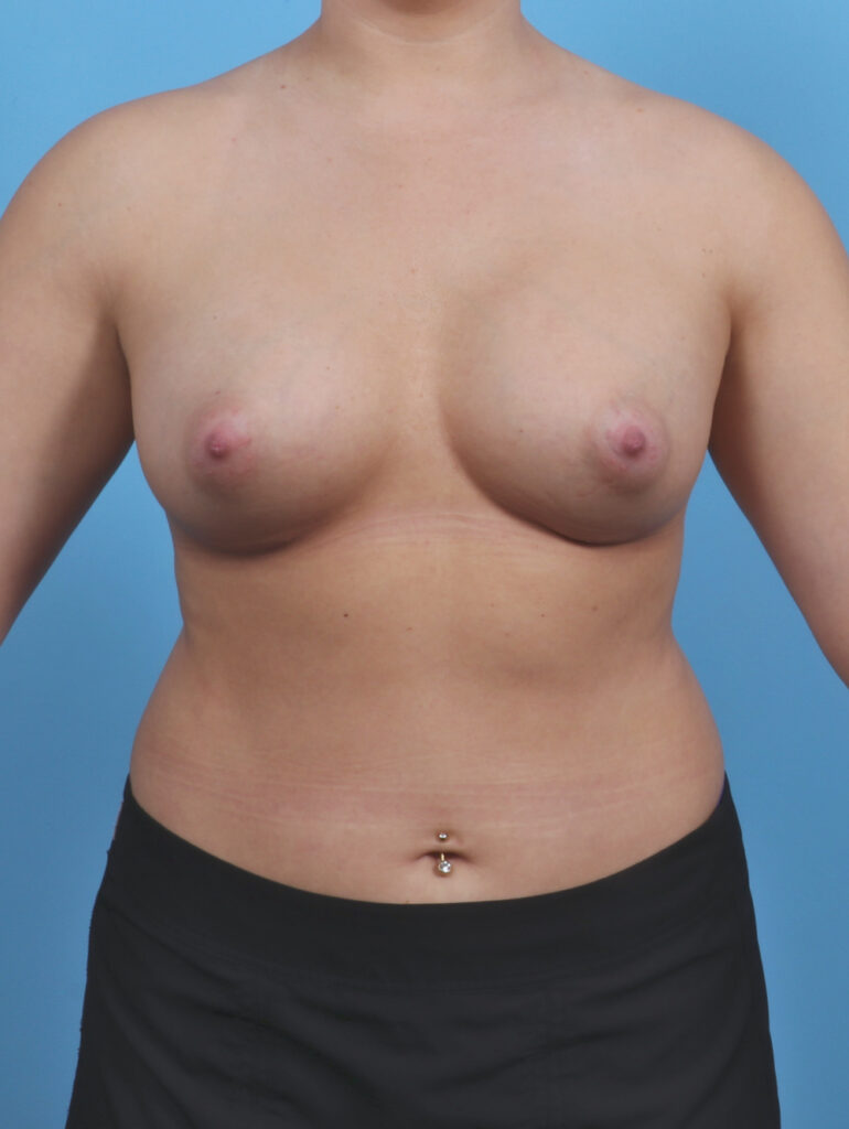 Breast Augmentation - Case 4934 - After