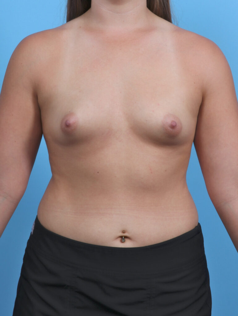 Breast Augmentation - Case 4934 - Before