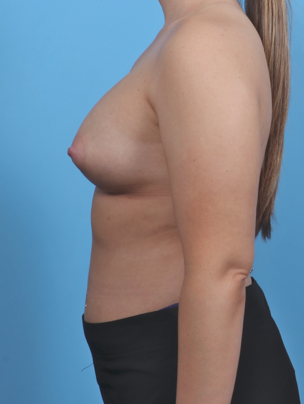 Breast Augmentation Patient Photo - Case 4934 - after view-2