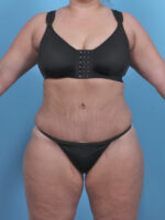 Tummy Tuck - Case 4954 - After