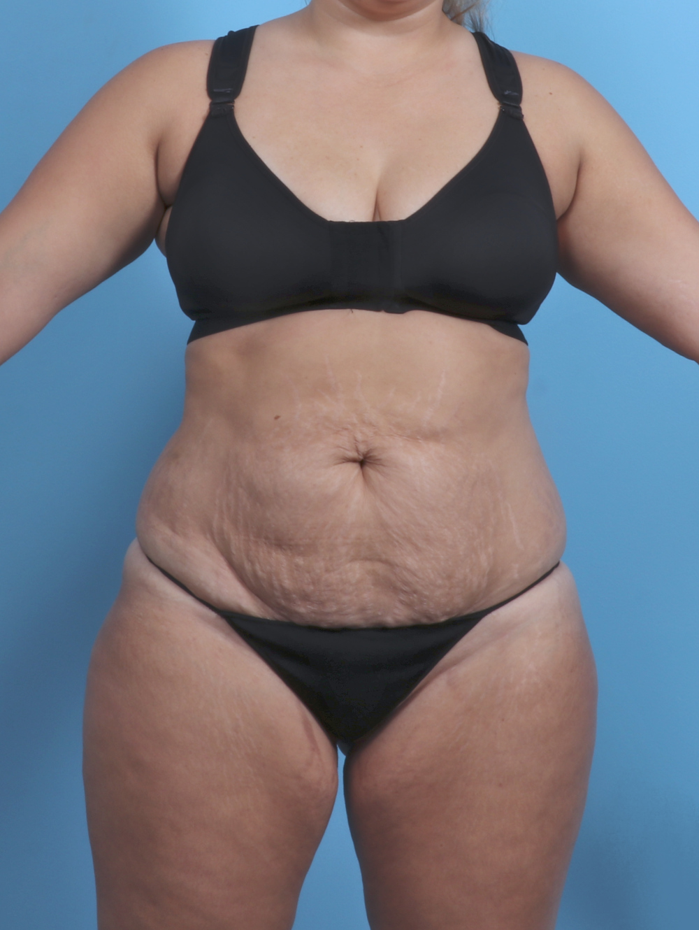 Tummy Tuck Patient Photo - Case 4954 - before view-