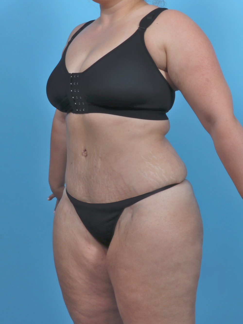 Tummy Tuck Patient Photo - Case 4954 - after view-1