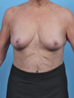 Breast Lift/Reduction - Case 4963 - After