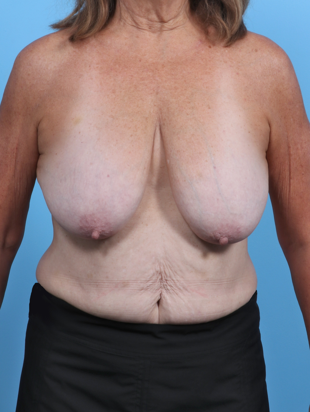 Breast Lift/Reduction Patient Photo - Case 4963 - before view-0