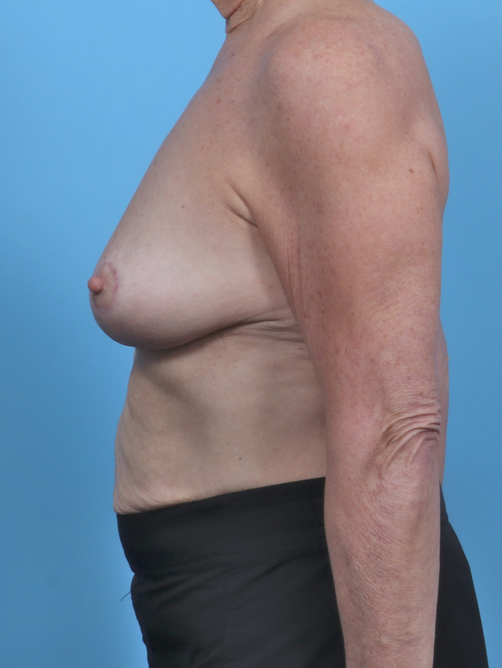 Breast Lift/Reduction Patient Photo - Case 4963 - after view-2