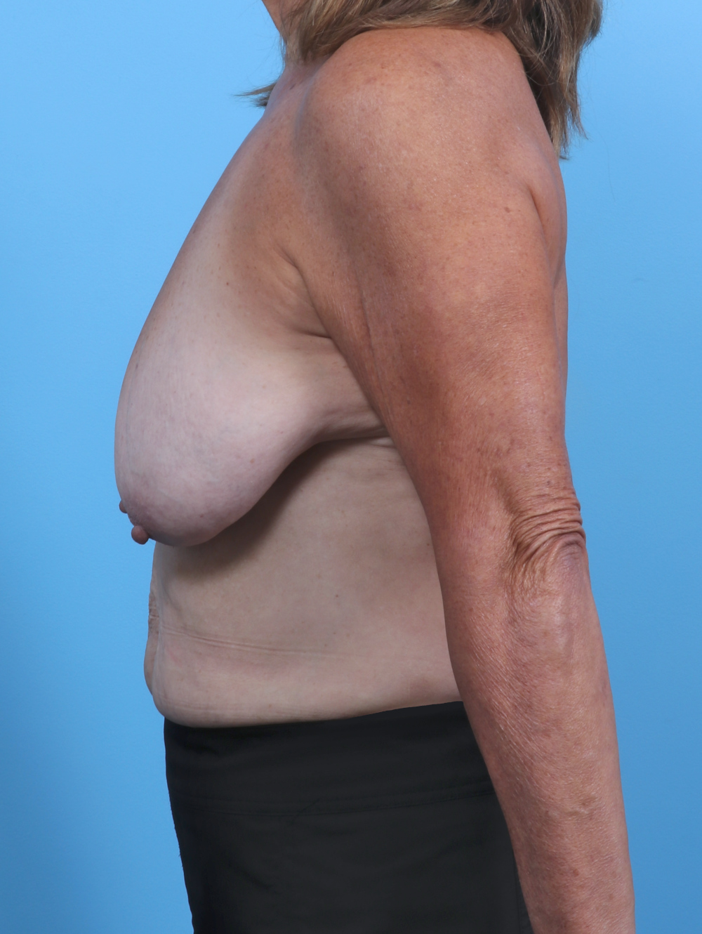 Breast Lift/Reduction Patient Photo - Case 4963 - before view-2