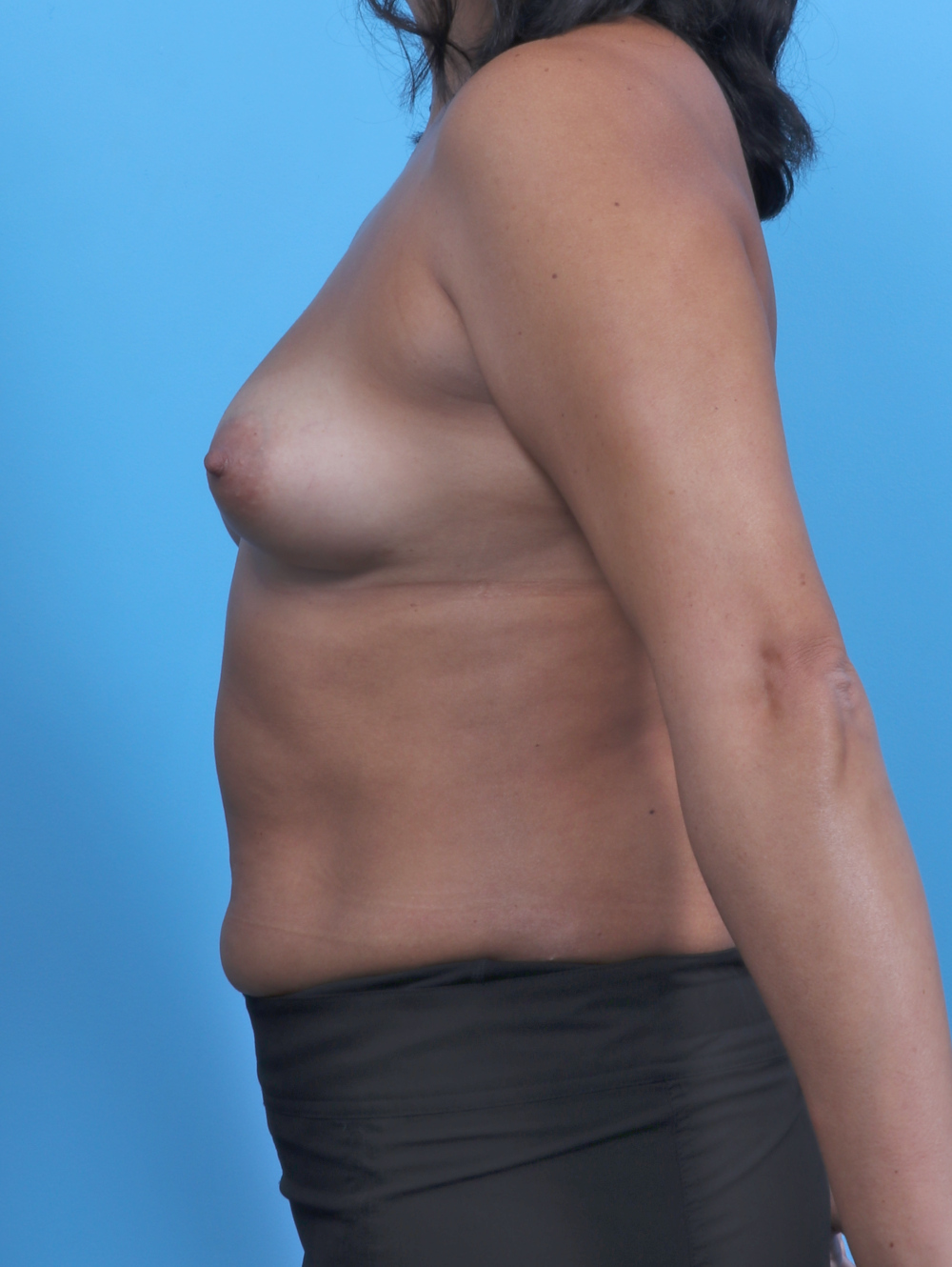 Breast Augmentation Patient Photo - Case 5021 - before view-2