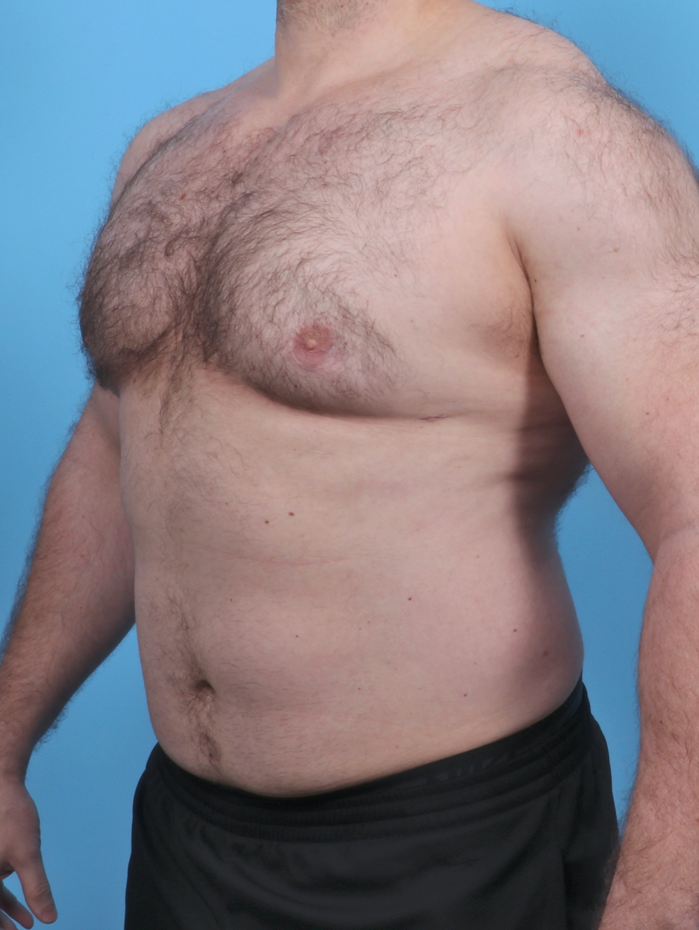 Male Breast Reduction Patient Photo - Case 5042 - after view-1