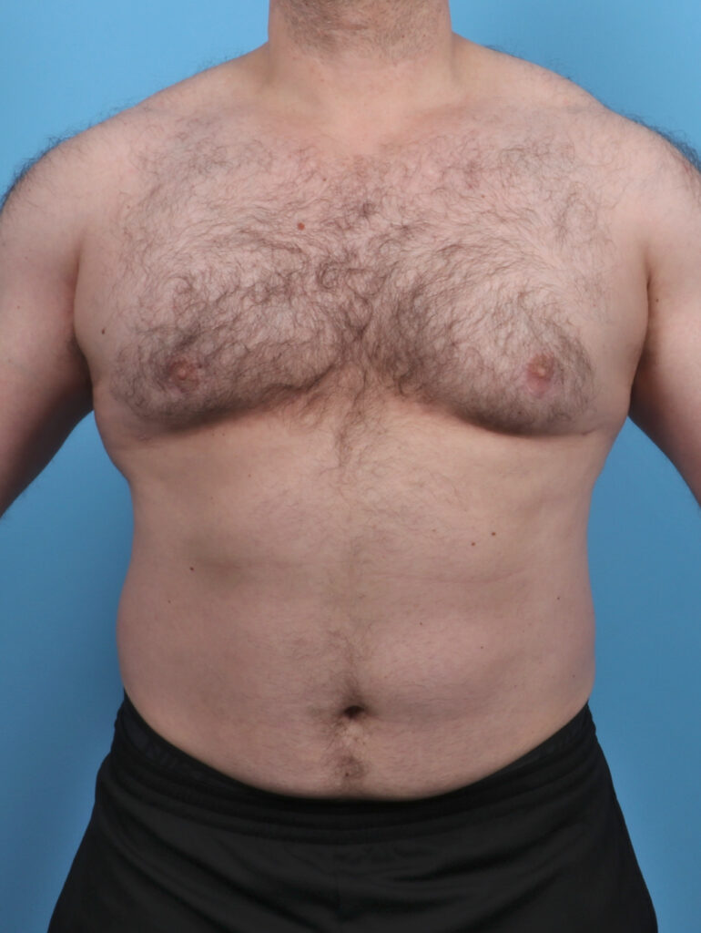 Male Breast Reduction - Case 5042 - After