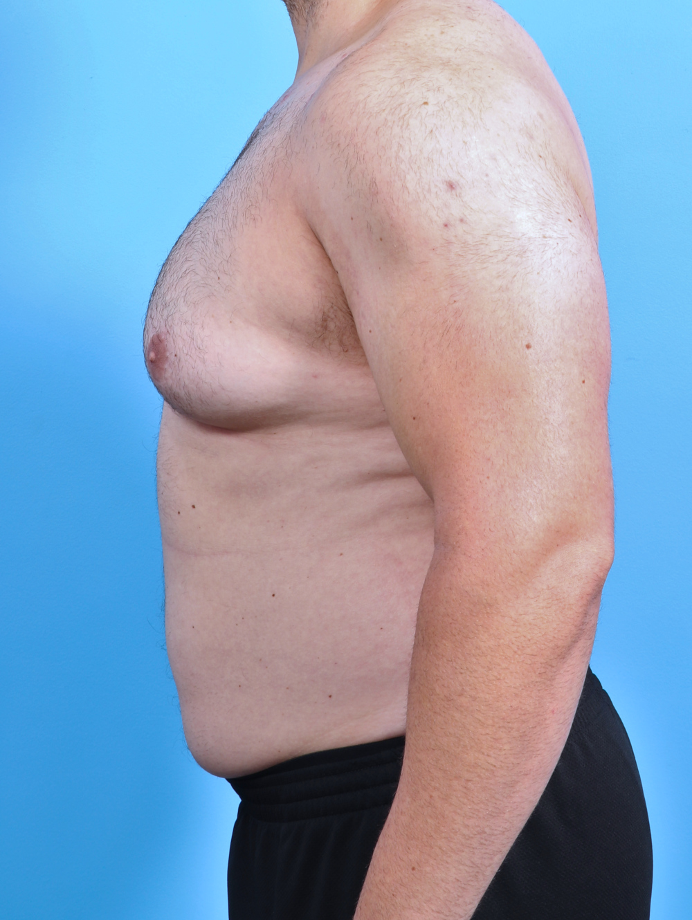 Male Breast Reduction Patient Photo - Case 5042 - before view-2