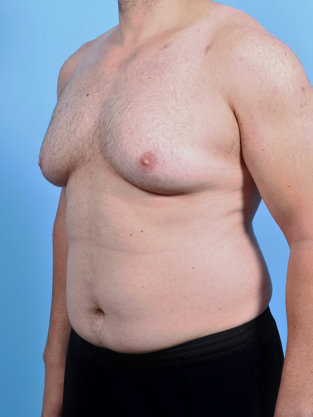 Male Breast Reduction Patient Photo - Case 5042 - before view-1