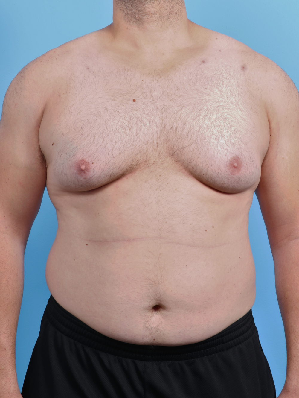 Male Breast Reduction Patient Photo - Case 5042 - before view-0