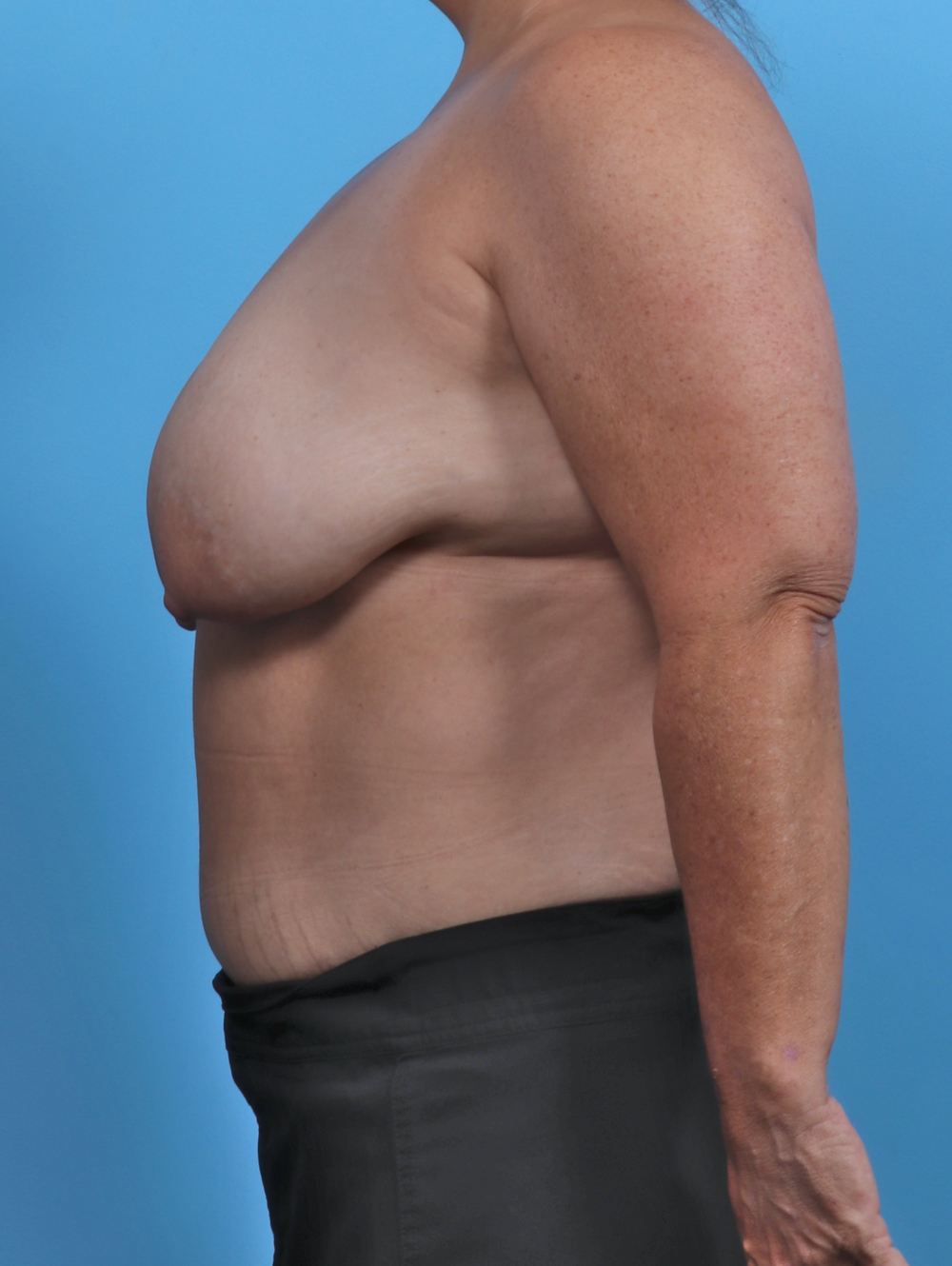 Breast Lift/Reduction Patient Photo - Case 5068 - before view-2