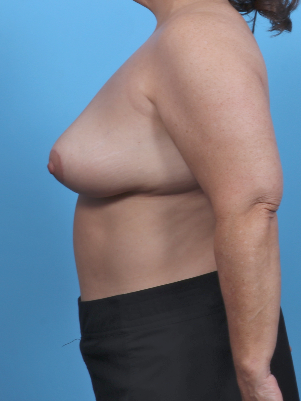 Breast Lift/Reduction Patient Photo - Case 5068 - after view-2