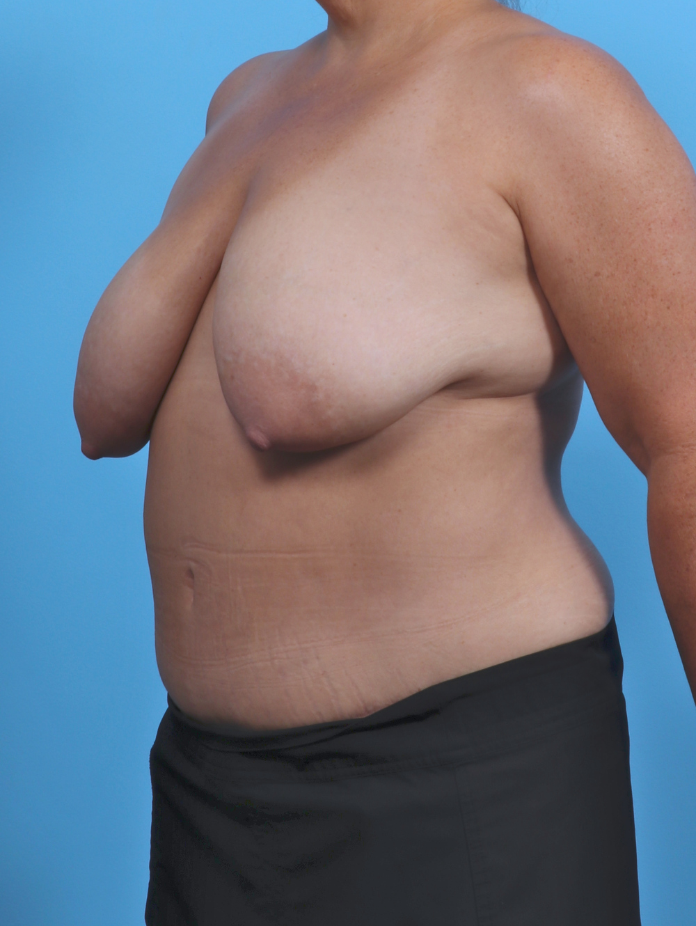 Breast Lift/Reduction Patient Photo - Case 5068 - before view-1