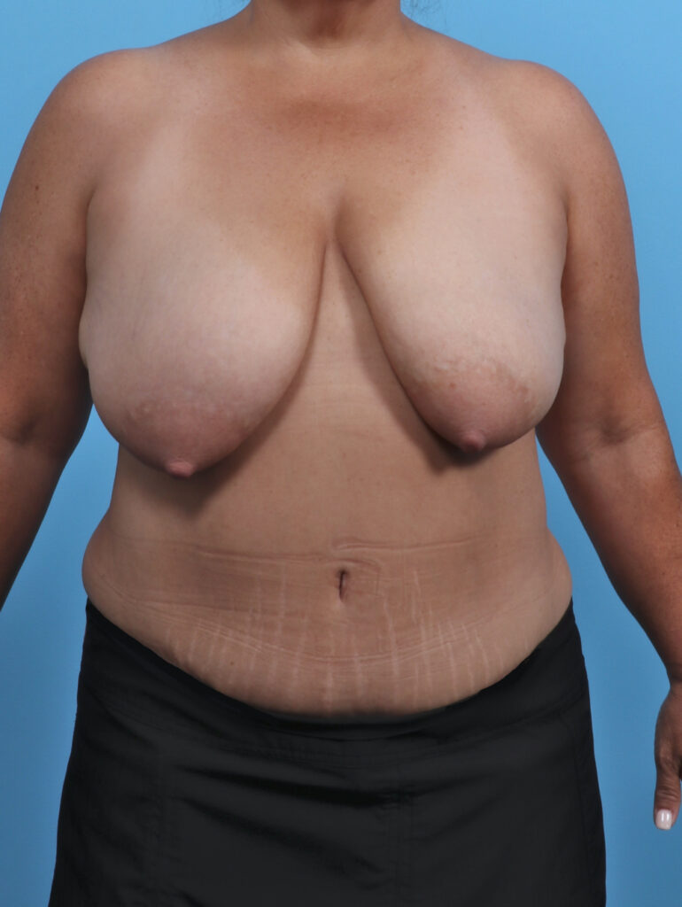 Breast Lift/Reduction - Case 5068 - Before