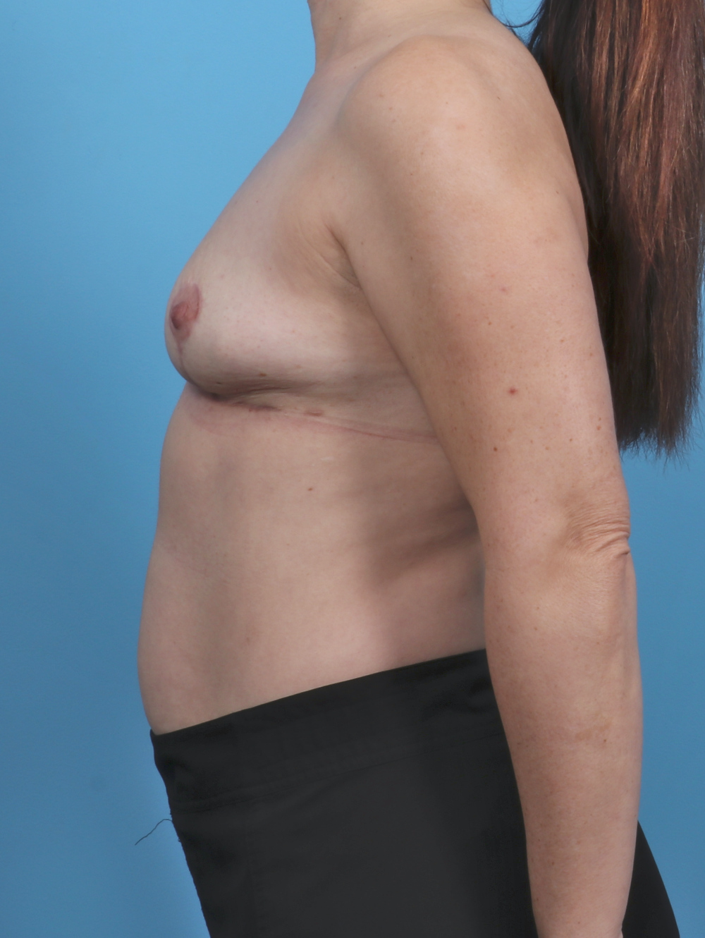 Breast Lift/Reduction Patient Photo - Case 5084 - after view-2