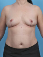 Breast Lift/Reduction - Case 5084 - After