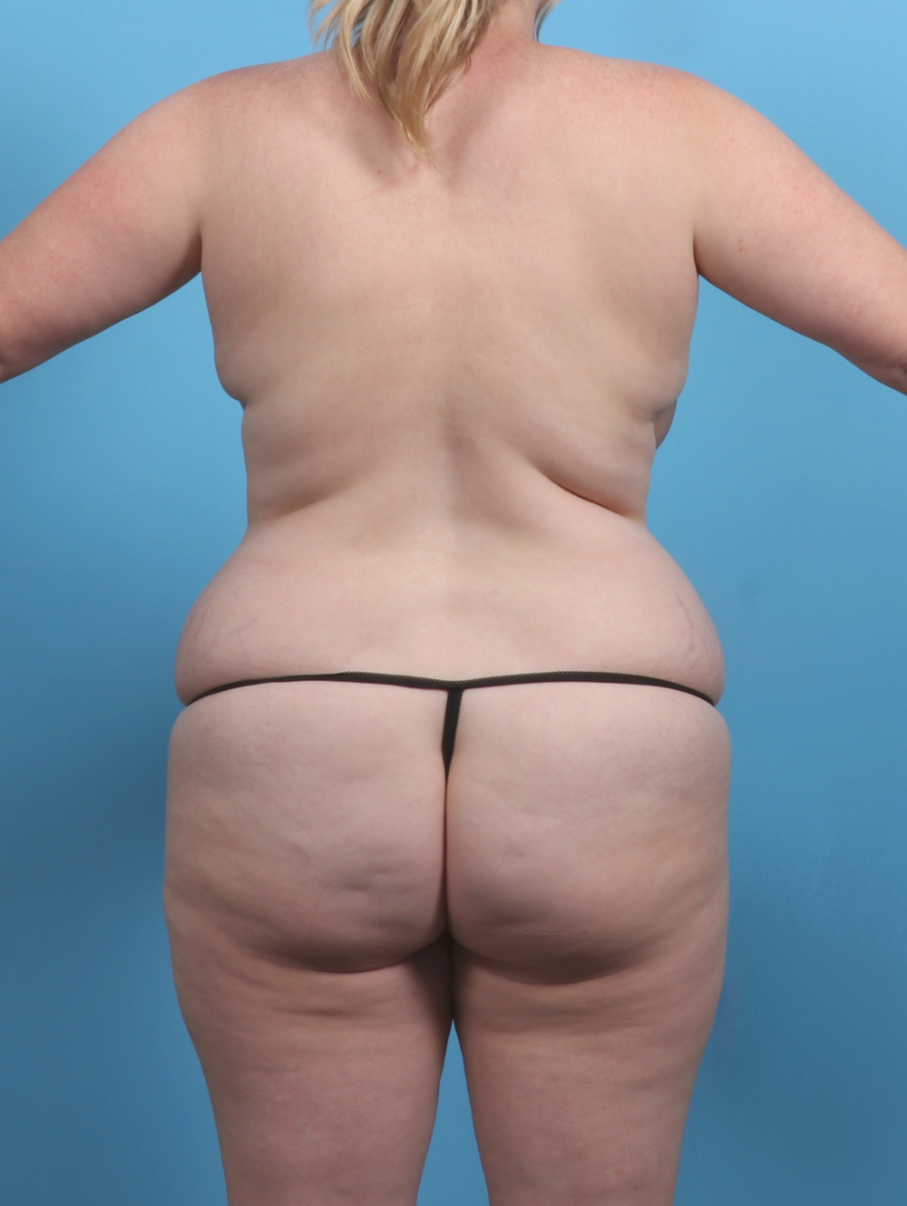 Liposuction Patient Photo - Case 5092 - before view-3