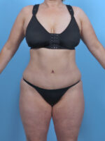 Liposuction - Case 5092 - After