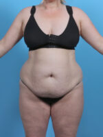 Liposuction - Case 5092 - Before