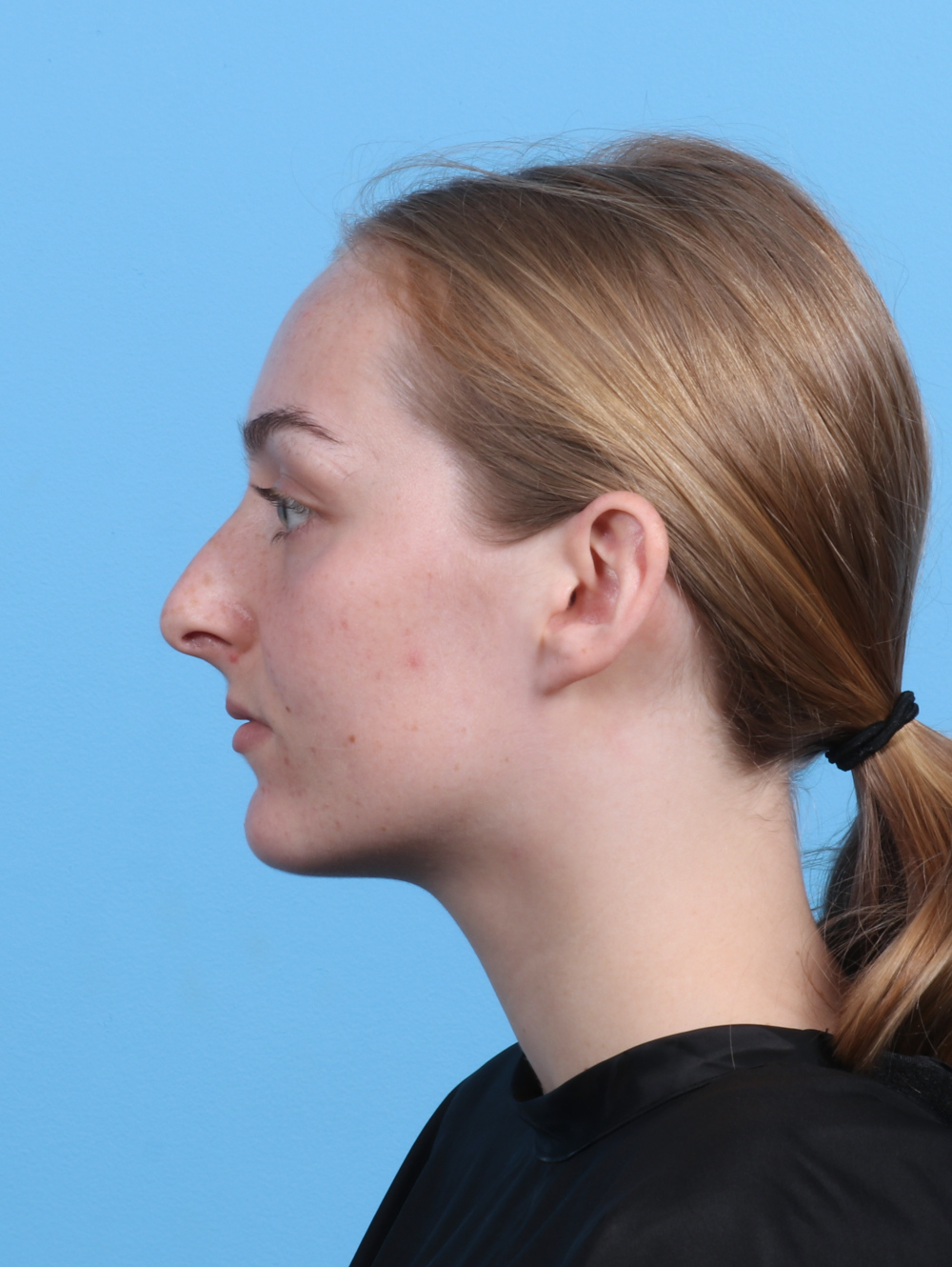 Rhinoplasty Patient Photo - Case 5103 - before view-0
