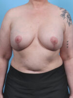 Breast Implant Revision - Case 5126 - After