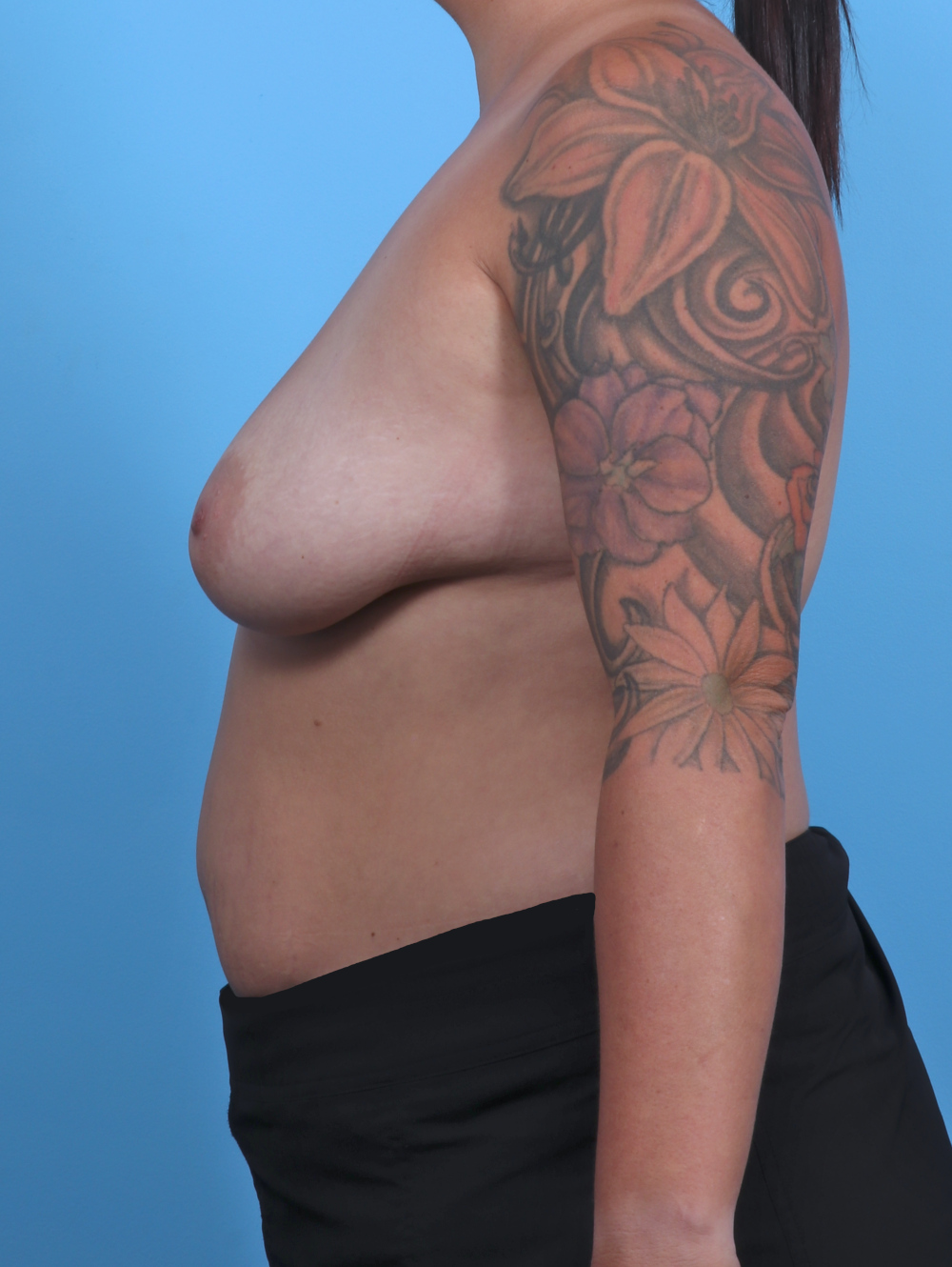 Breast Lift with Implants Patient Photo - Case 5140 - before view-2