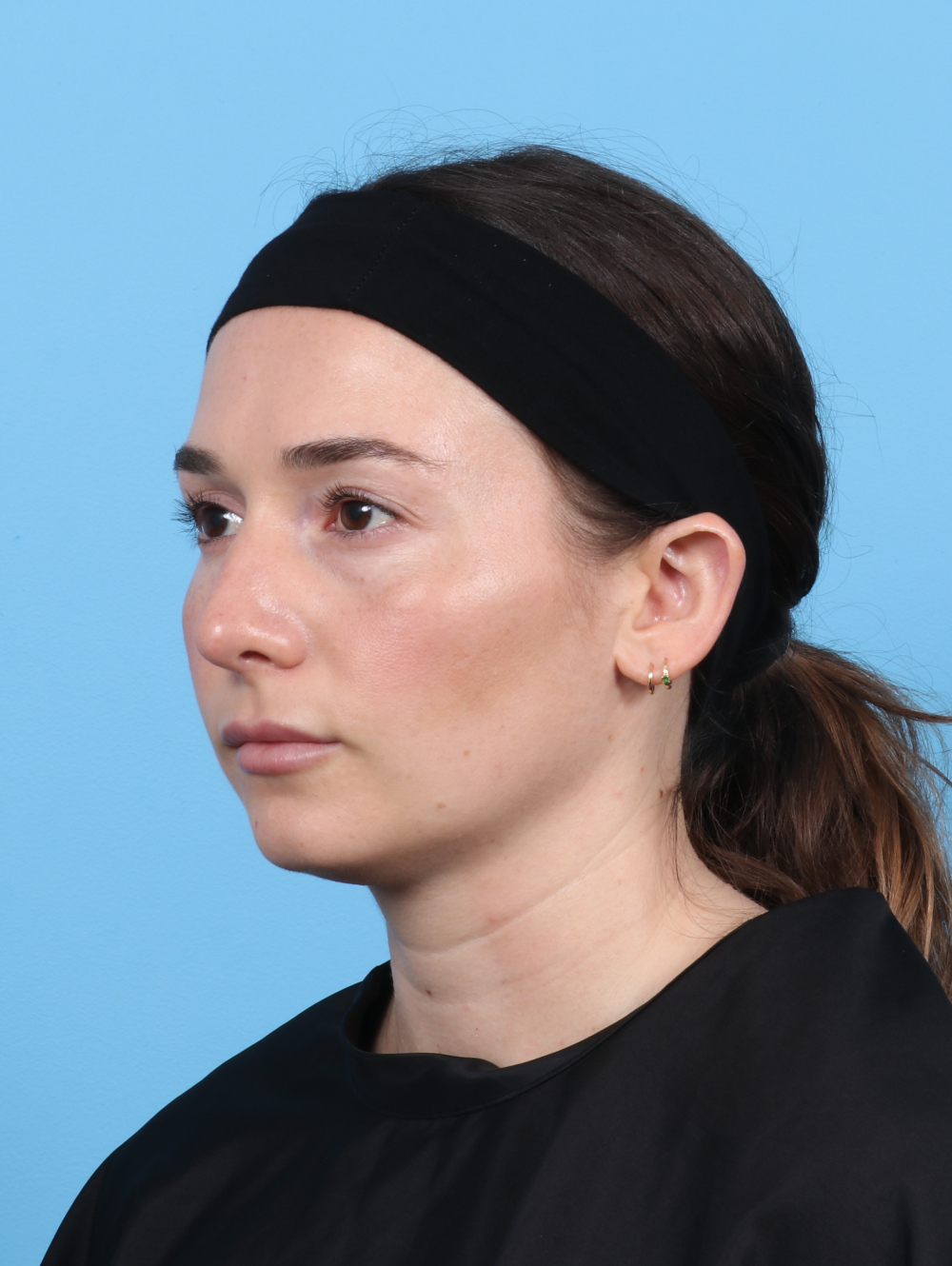 Rhinoplasty Patient Photo - Case 5325 - after view-2