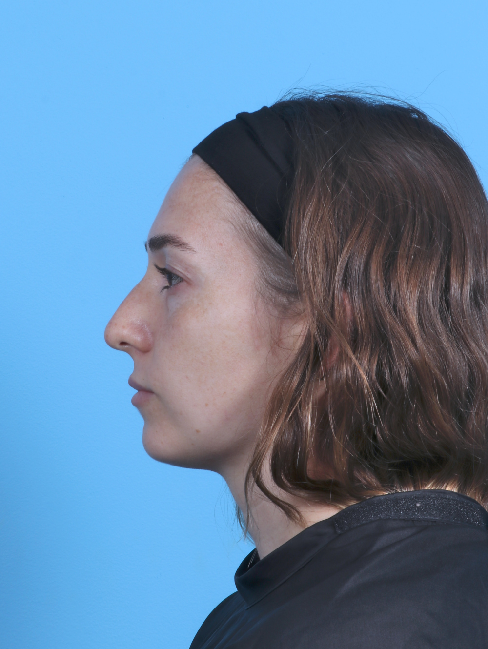 Rhinoplasty Patient Photo - Case 5325 - before view-
