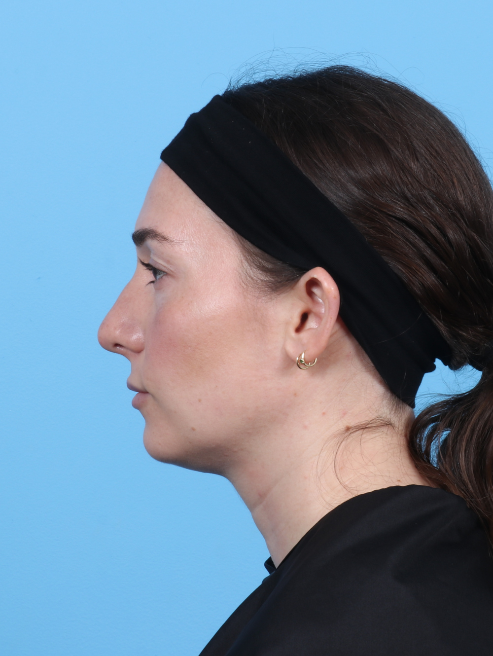Rhinoplasty Patient Photo - Case 5325 - after view-0