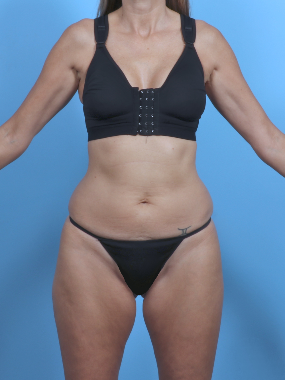 Tummy Tuck Patient Photo - Case 5333 - before view-