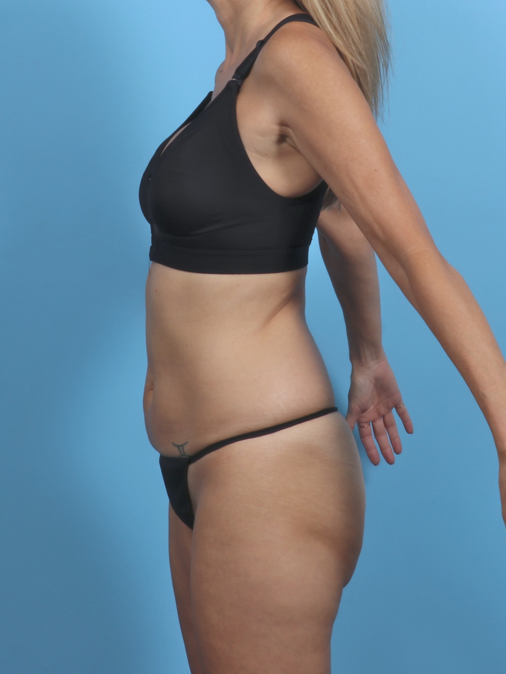 Tummy Tuck Patient Photo - Case 5333 - before view-2
