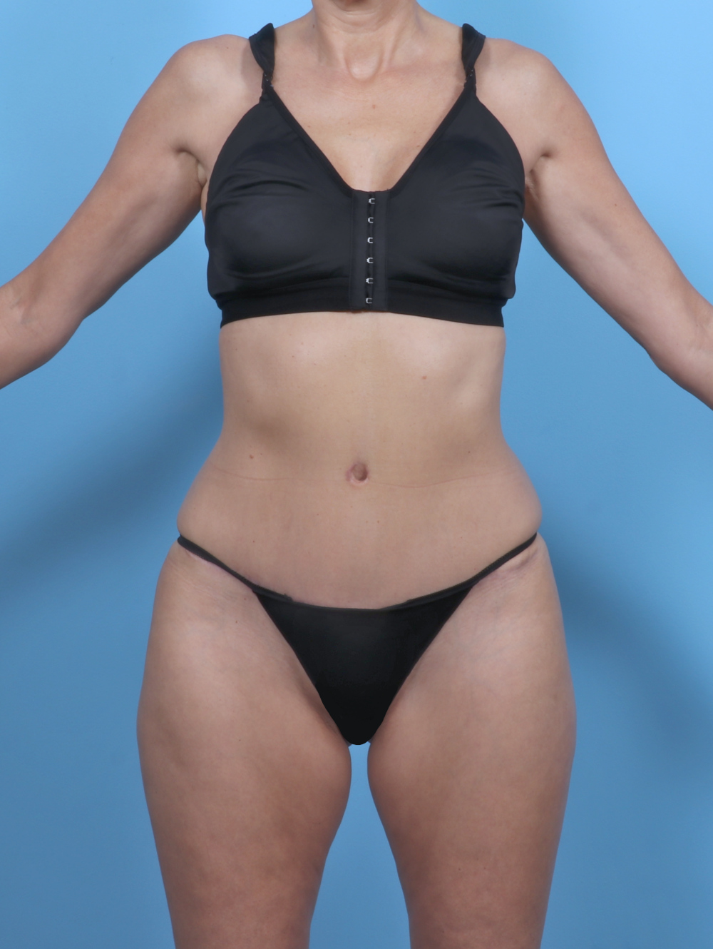 Tummy Tuck Patient Photo - Case 5333 - after view-0