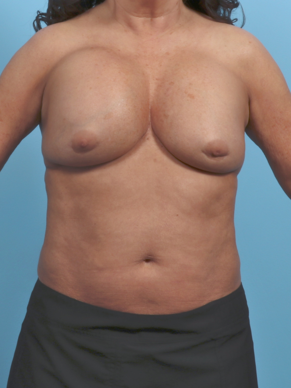 Breast Implant Revision Patient Photo - Case 5359 - before view-0
