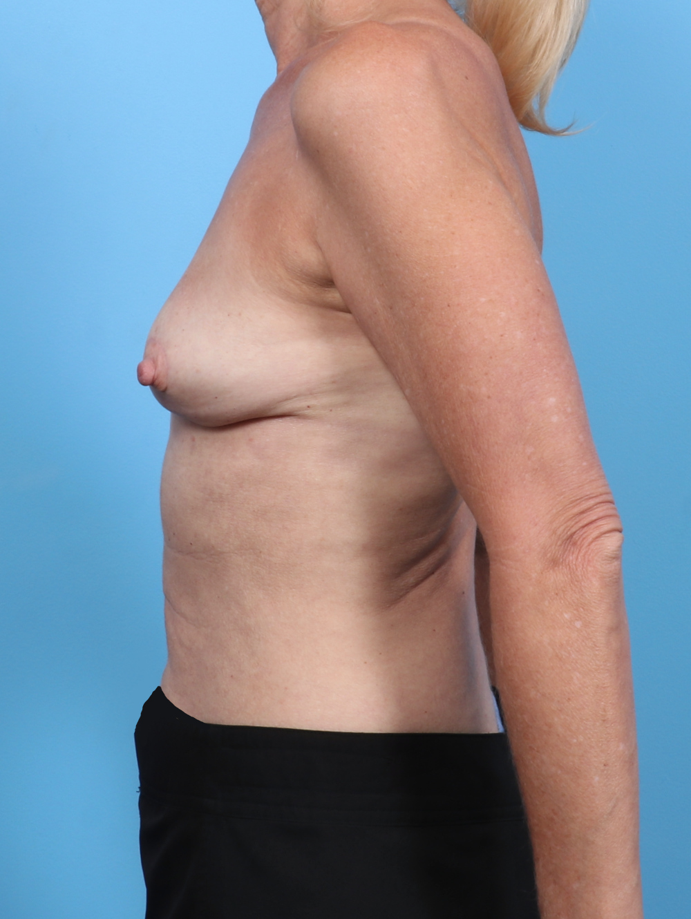 Breast Implant Revision Patient Photo - Case 5367 - after view-2