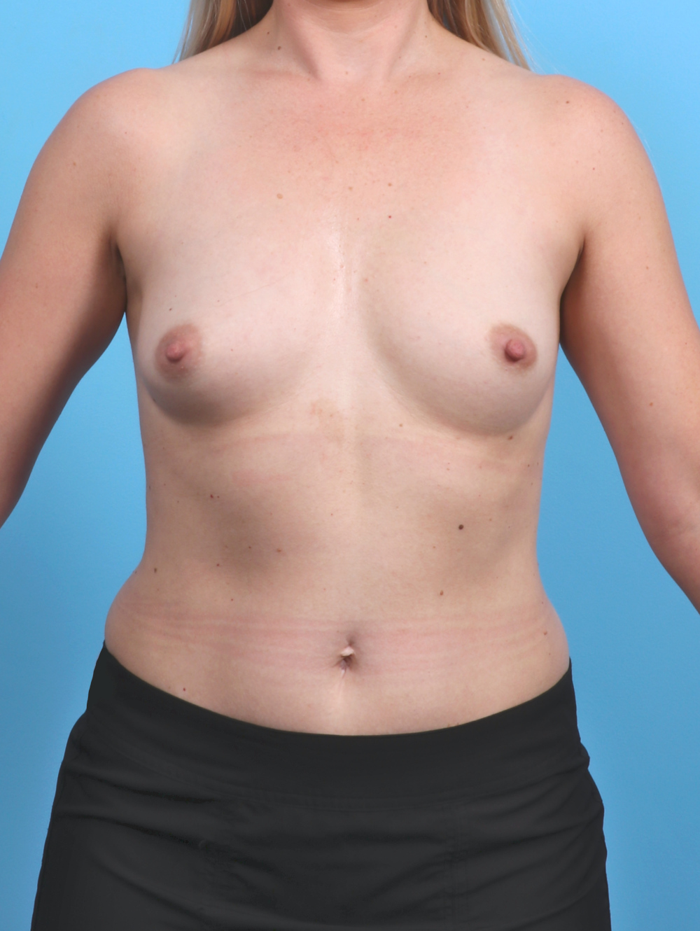 Breast Augmentation Patient Photo - Case 5466 - before view-