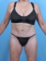 Tummy Tuck - Case 5474 - After
