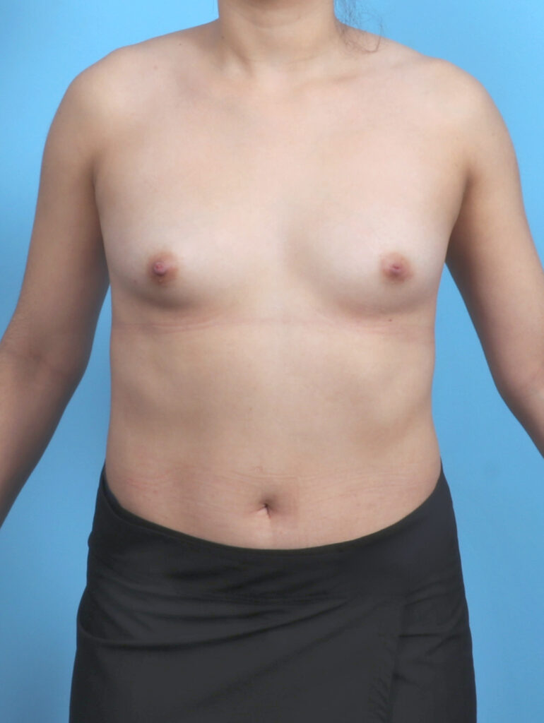 Breast Augmentation - Case 5498 - Before
