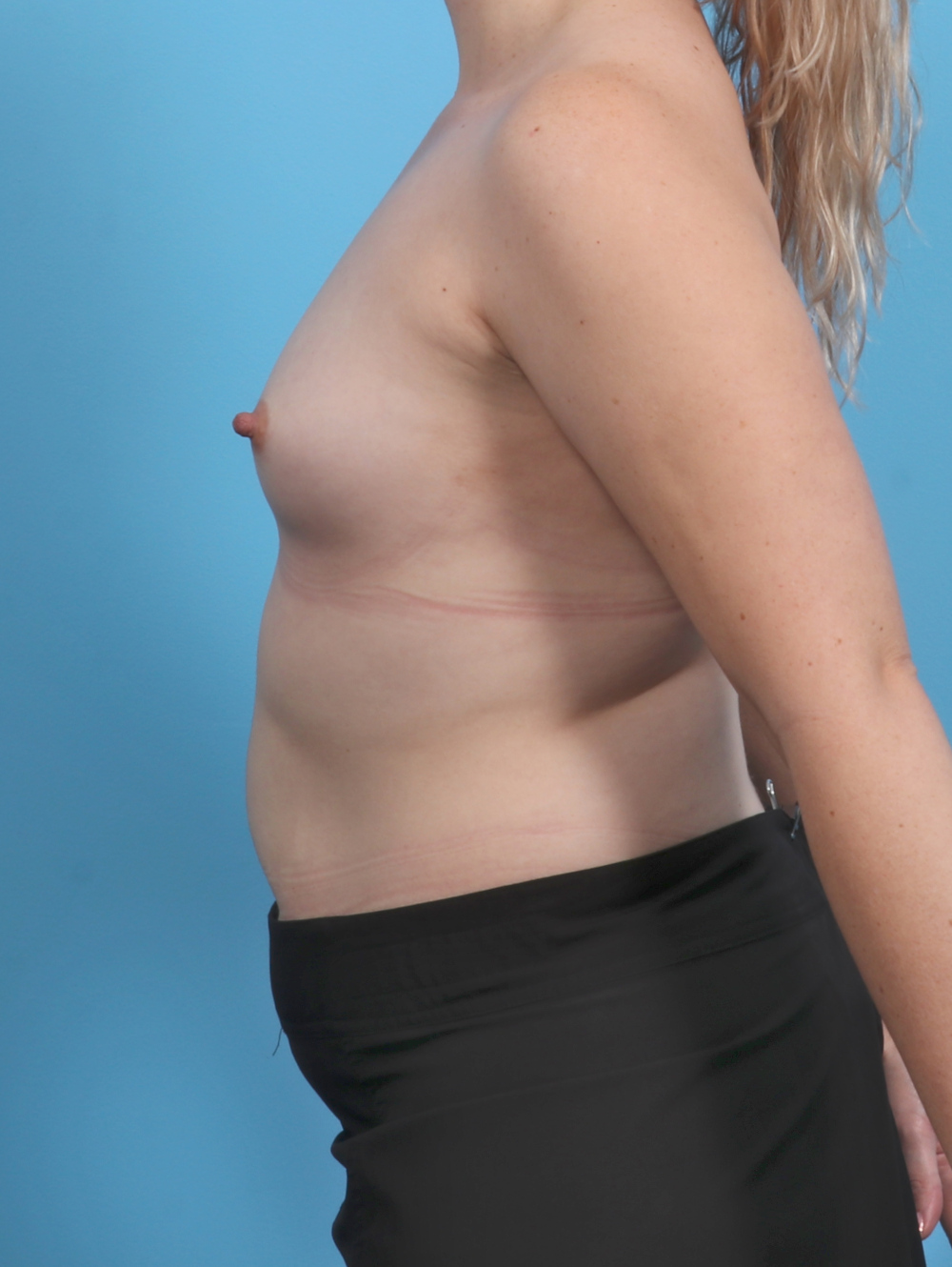Breast Augmentation Patient Photo - Case 5506 - before view-2
